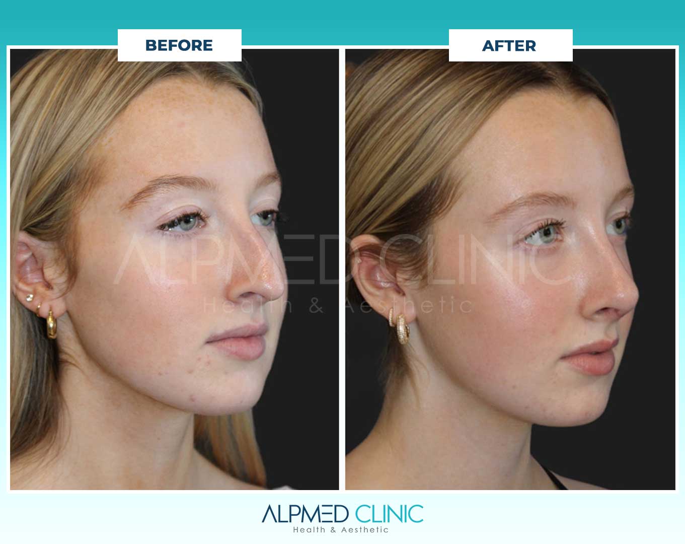 rhinoplasty-before-after-6